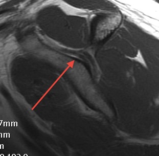 Suprascapular Nerve Sagittal MRI 1